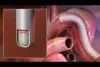 gore tag conformable thoracic stent graft with active control system deployment