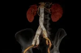 SVS Clinical Practice Guidelines for Abdominal Aortic Aneurysm* (AAA)