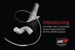 Introducing the GORE® TAG® Conformable Thoracic Stent Graft with ACTIVE CONTROL System