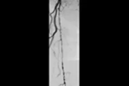Angiogram of chronic occlusions in superficial femoral artery.