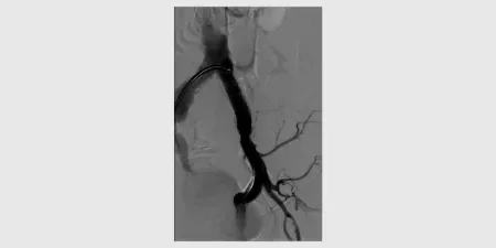 Post VBX Stent Graft deployment with contrast