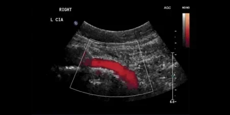 VBX Stent Graft flexibility and patency shown in discharge ultrasound