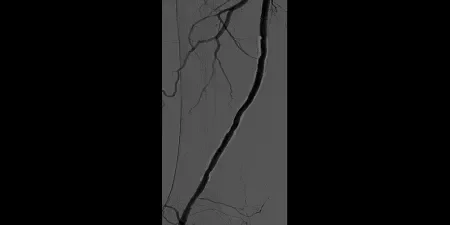 Angiogram showing result