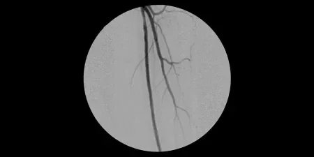 Completion angiogram