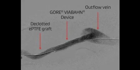 An 8 mm x 5 cm GORE® VIABAHN® Device placed at the venous anastomosis.
