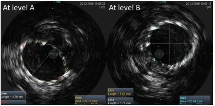 IVUS images of a GORE® TIGRIS® Vascular Stent at levels A and B