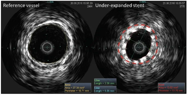  IVUS images of a conventional nitinol stent in the distal SFA