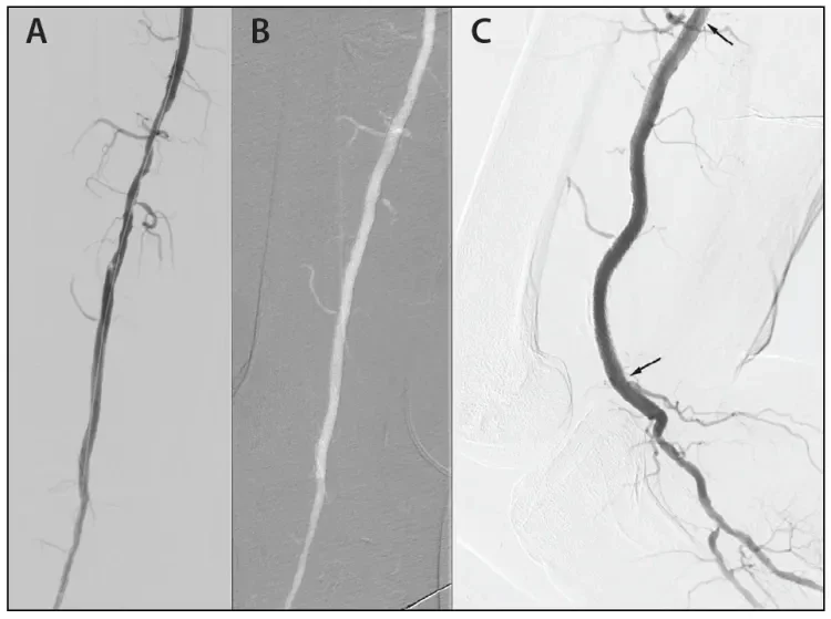 Residual irregularity in the popliteal artery