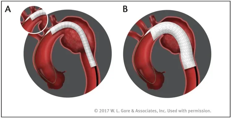 Staged deployment allows the device to first be opened to an intermediate diameter along its entire length while ensuring continuous blood flow (A). A separate deployment step expands the device to its full diameter (B).