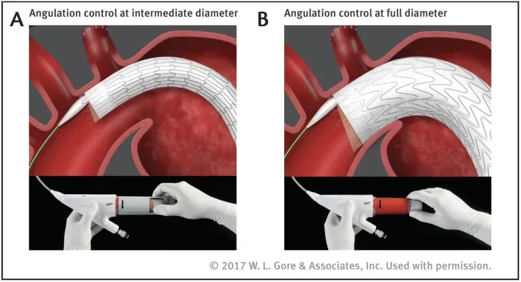 The optional angulation feature can be used at both intermediate (A) and full (B) diameter stages. By nesting the stent rows along the inner aortic curve, angulation helps to achieve orthogonal device placement in tight arches.