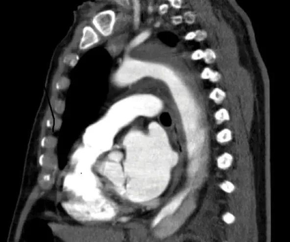 A CT scan showing a type B aortic dissection treated by best medical treatment.