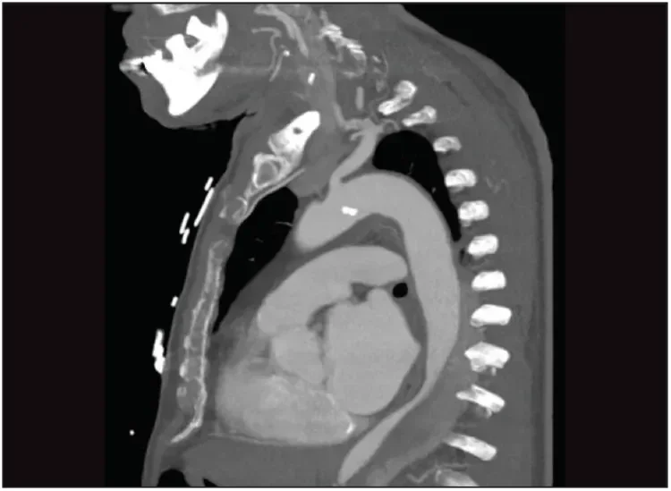 One year later, the patient presented with thoracic pain. The CT scan shows remodeling of the proximal descending aorta with an aneurysm of the false lumen and collapse of the true lumen.