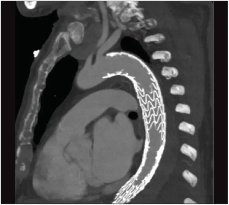 The postoperative CT scan shows exclusion of the aneurysm with no endoleak and good perfusion of the left subclavian artery.