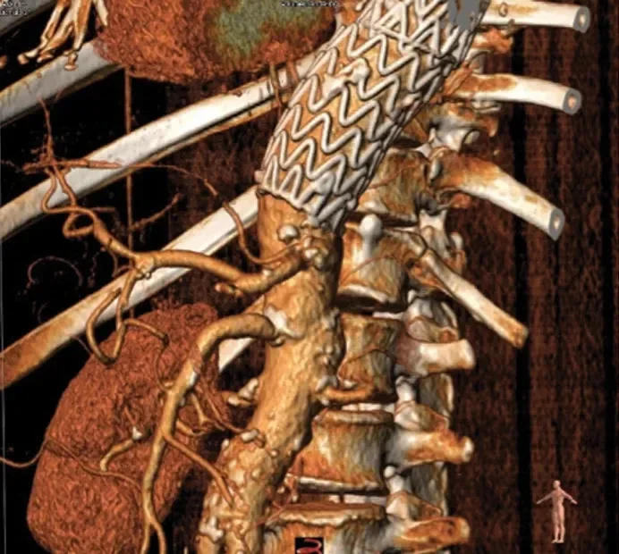 Accurate placement of the distal device at the level of the celiac trunk.