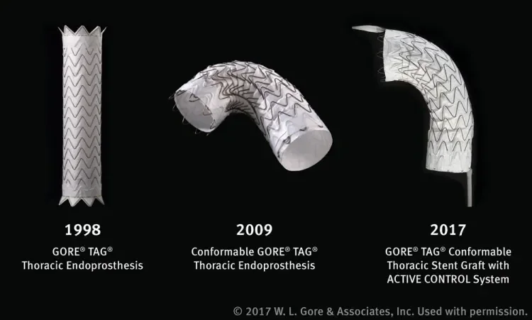 The evolution of Gore’s TEVAR device, from the original GORE® TAG® Device to the Conformable GORE® TAG® Endoprosthesis and, most recently, the new GORE® TAG® Conformable Thoracic Stent Graft with ACTIVE CONTROL System.