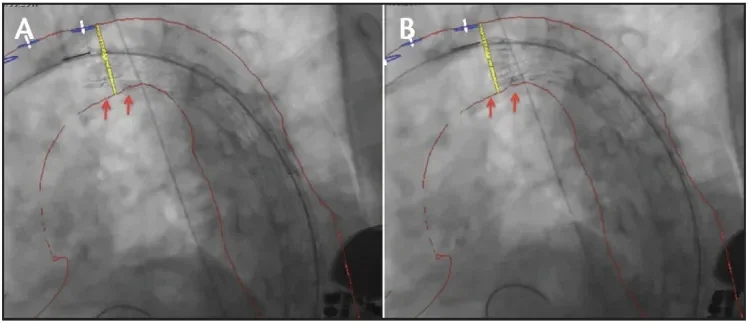 Intraoperative fluoroscopy before (A) and after (B) angulation and refinement of stent graft position at the intermediate stage of deployment. The red arrows indicate the improved apposition of the device at the inner arch curvature.