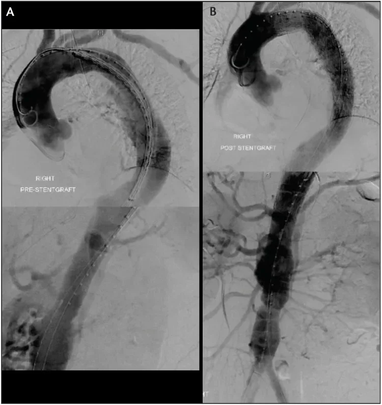 A 56-year-old man presented with an acute complicated TBAD with visceral and left lower extremity malperfusion. He was treated with two Conformable GORE® TAG® Devices. The pre-TEVAR imaging demonstrates poor filling of the mesenteric vessels (A), whereas the post-TEVAR imaging shows brisk filling throughout the renovisceral segment as well as both iliac arteries after TEVAR (B)
