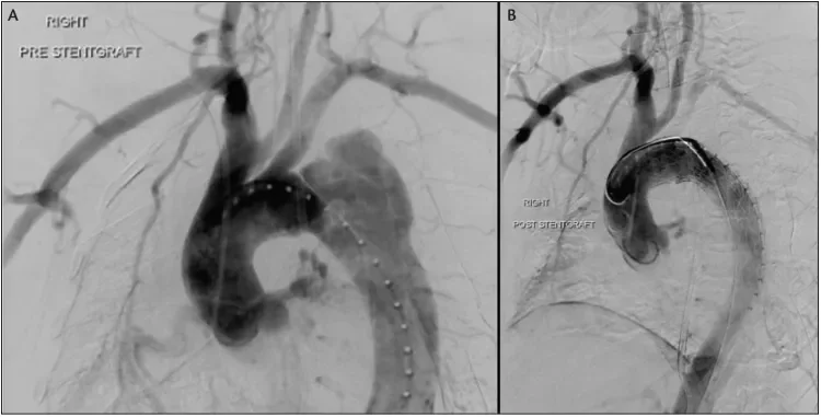 During TEVAR, angiography revealed interval development of a contained rupture (A). IVUS confirmed that the dissection extended into the distal aortic arch. The operative plan was modified, and a Conformable GORE® TAG® Device was deployed with intentional LSA coverage. A completion angiogram revealed adequate filling of the LSA through retrograde vertebral flow, exclusion of the diseased aorta, and brisk distal TL filling (B). She was followed expectantly and did not require LSA revascularization.