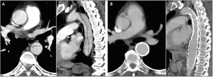 A 75-year-old man presented with an acute complicated TBAD with a large fenestration in the mid descending thoracic aorta (A). TEVAR resulted in exclusion of the diseased aorta, with excellent aortic remodeling seen at 6 months and no endoleak (B).