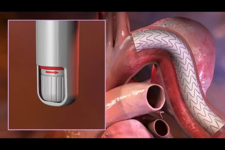 gore tag conformable thoracic stent graft with active control system deployment