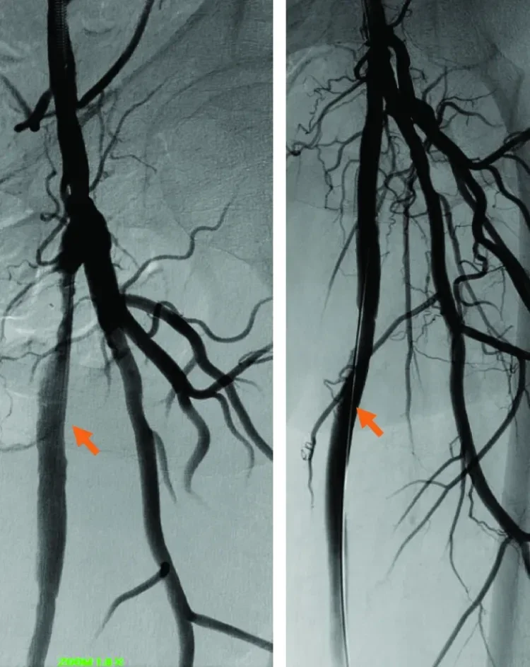 Figure 3. Preintervention SFA, homogenous plaque noted in the vessel (A). Postintervention SFA after placement of GORE® VIABAHN® Endoprosthesis (B). Soft plaque is successfully trapped by the stent.