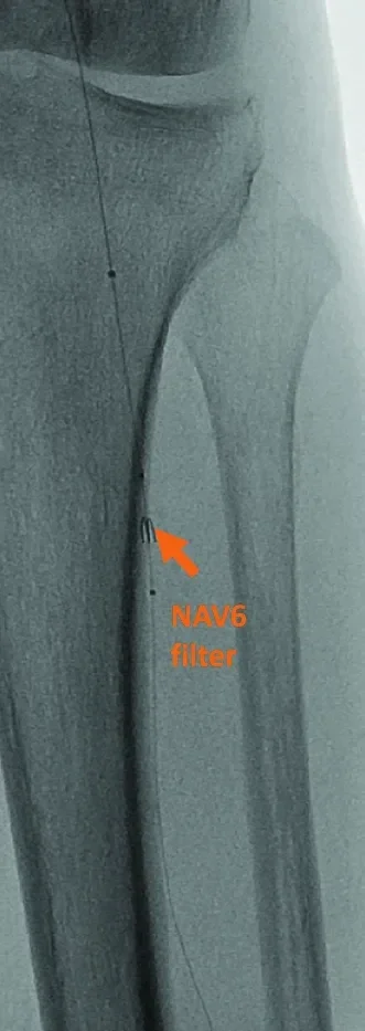 Figure 5. ABBOTT® EMBOSHIELD NAV6 Embolic Protection System deployed in the distal peroneal prior to protect sole outflow vessel.