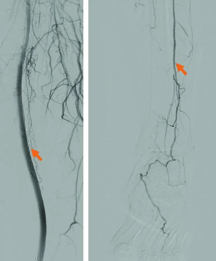 Figure 6. Postintervention. Revascularized distal SFA— popliteal (A). Direct inline flow to distal vascular bed from the peroneal artery (B).