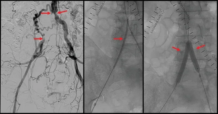 Figure 1. Baseline angiography revealed a small-caliber aorta with an occluded right common iliac artery (left arrows) and a high-grade stenosis of the left common iliac artery at its origin (right arrow). The ongoing external iliac arteries and bilateral internal iliac arteries were patent (A). The right common iliac artery occlusion was successfully crossed and then predilated with a 4-mm balloon (arrow) (B). After predilation, a 7- X 59-mm GORE® VIABAHN® VBX Balloon Expandable Endoprothesis (VBX Stent Gr