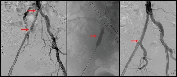 Figure 2. After initial stent deployment, there was excellent stent expansion in the bilateral common iliac arteries, but a residual stenosis at the distal right common iliac artery near the origin of the right internal iliac artery (arrows) (A). A 7- X 29-mm VBX Stent Graft was deployed (arrow), while taking care to not occlude the internal iliac artery (B). Final angiography revealed excellent stent expansion and flow throughout the iliac arteries (C).