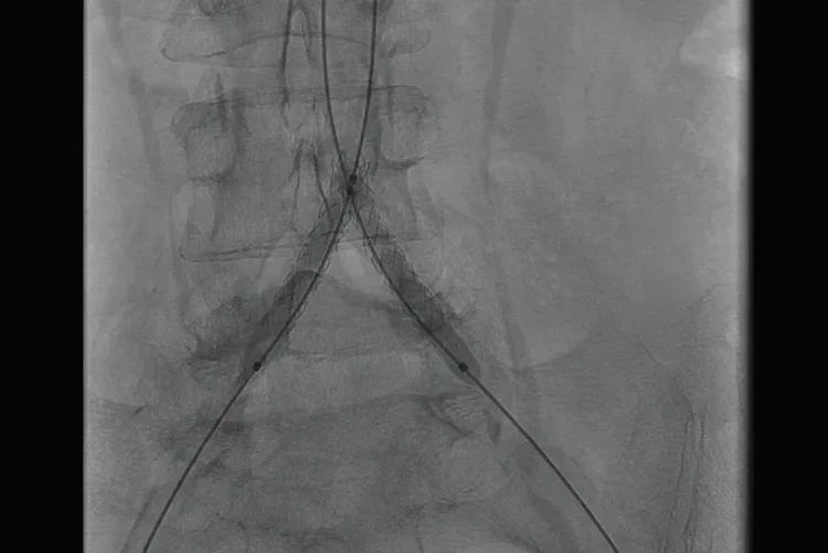 Figure 2. Deployment of bilateral common iliac artery GORE® VIABAHN® VBX Balloon Expandable Endoprosthesis kissing covered stents.