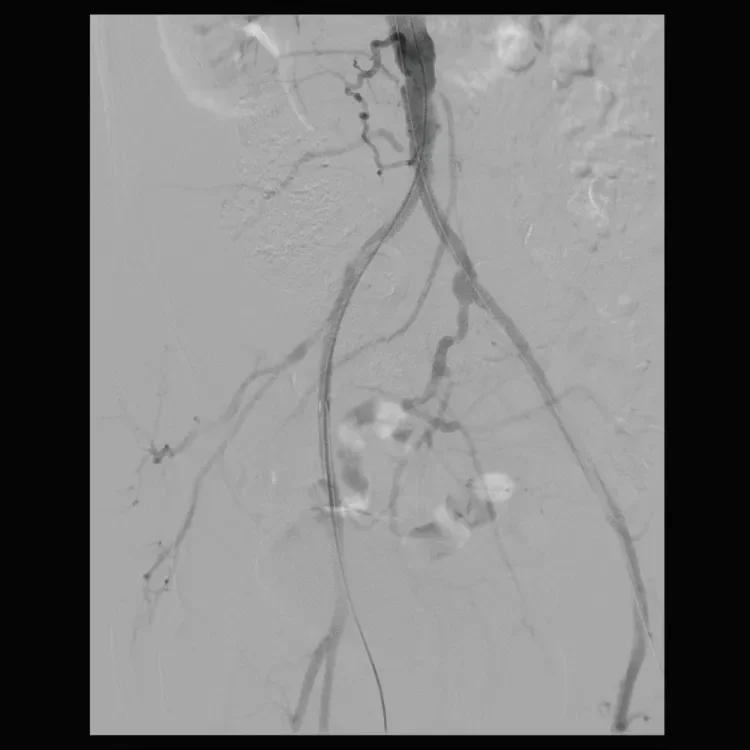 Figure 3. Excellent results can be seen on completion angiogram.