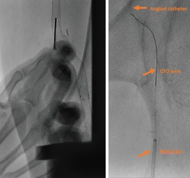 Figure 2. Angiography-guided (RAO 30º) access of the prior stent in the left SFA (A). Retrograde TERUMO GLIDEWIRE® Guidewire guided into angled COOK® CXI® Support Catheter to “floss” and externalize retrograde wire through the contralateral CFA access site (B).