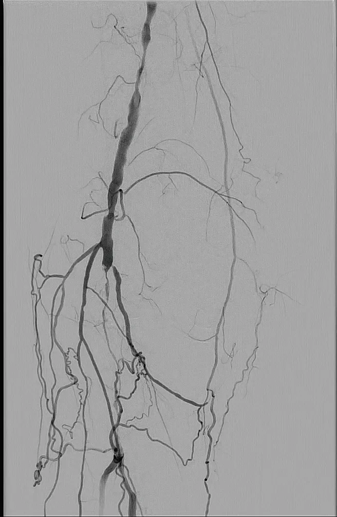 Figure 1. Severe TASC-D lesion of the distal SFA extending into the P2 segment.