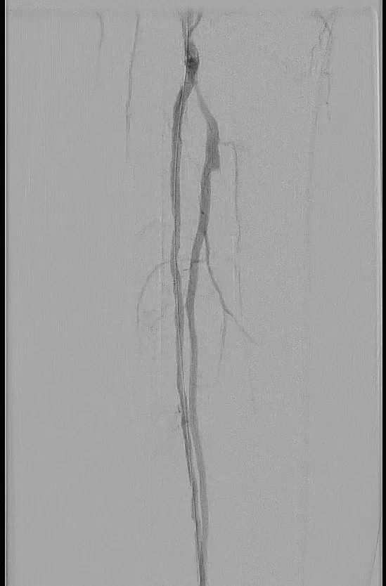 Figure 2. Two-vessel tibial runoff noted after reconstituting the artery.