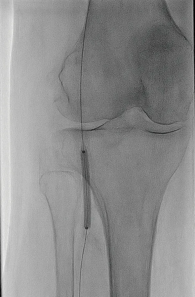 Figure 4. DCB therapy to the distal popliteal and tibioperoneal trunk.