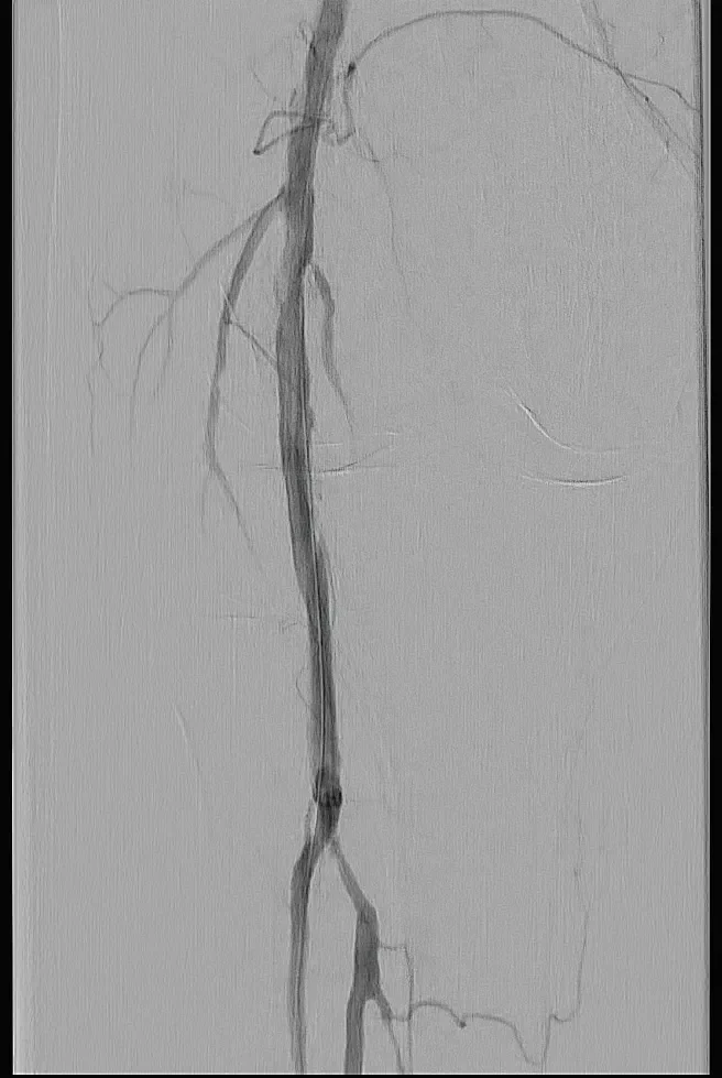 Figure 5. Predilatation shows extensive dissection, making successful DCB treatment unlikely.