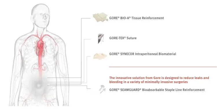 transparent man that illustrates where Gore Medical products are in the body