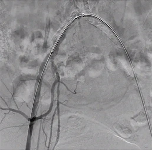 Video of ostial calcified lesion treatment using GORE VIABAHN VBX Balloon Stent graft