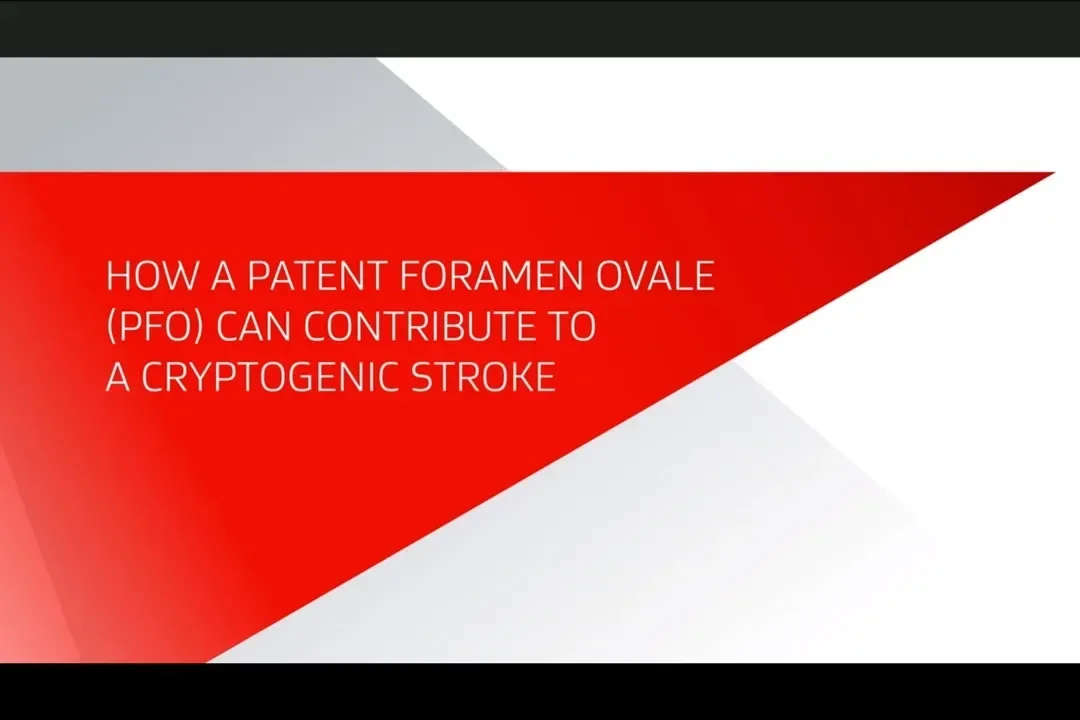 How a patent foramen ovale (PFO) can contribute to a cryptogenic stroke