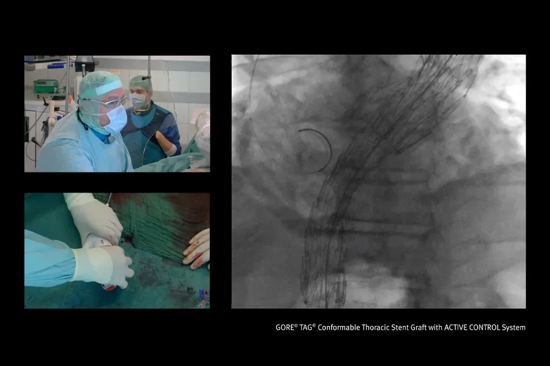 Dr Austermann Live Case #3 - Conformable GORE® TAG® Thoracic Stent Graft with ACTIVE CONTROL System