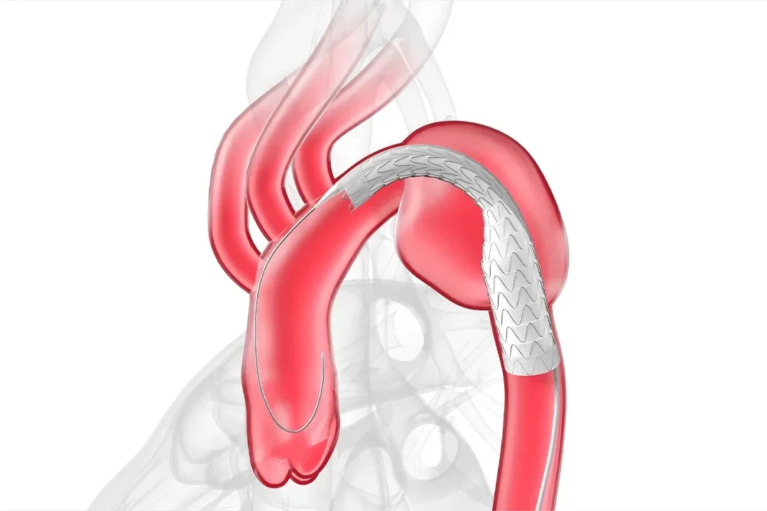GORE® TAG® Conformable Thoracic Stent Graft deployment animation