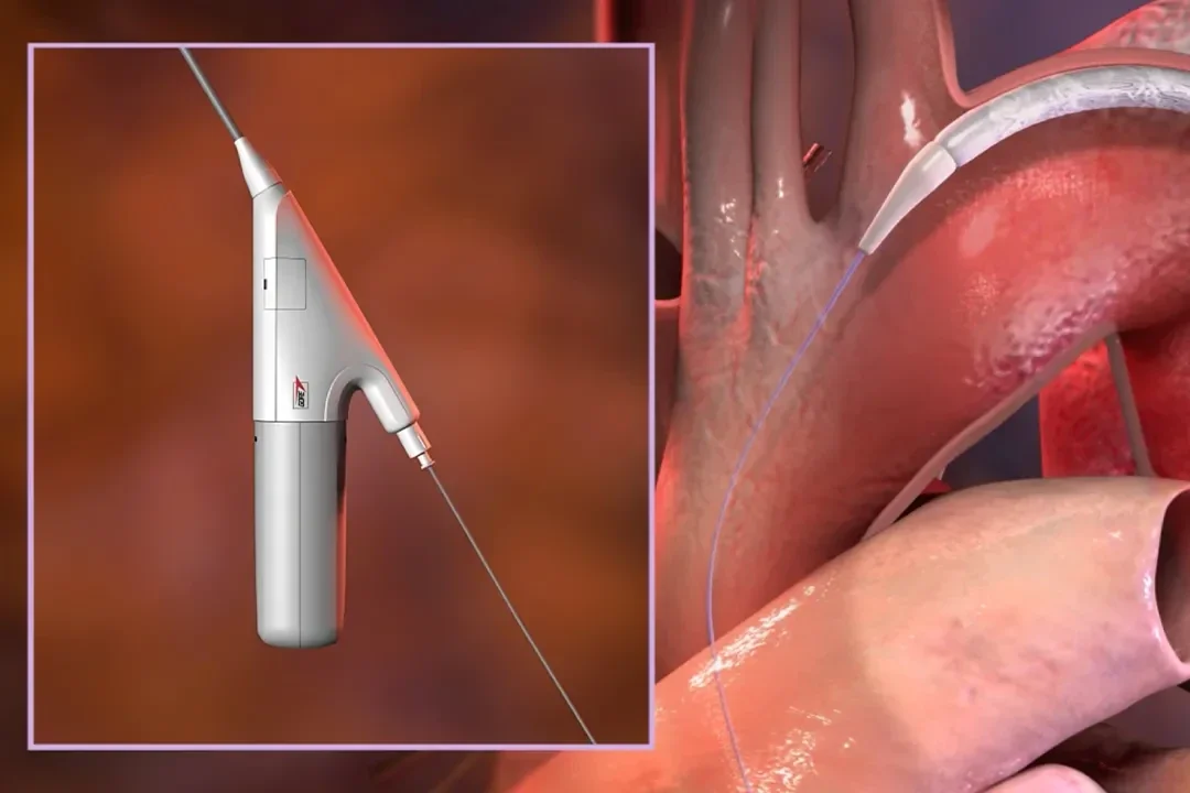 GORE® TAG® Conformable Thoracic Stent Graft System Animation