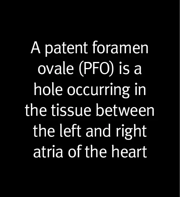 A patent foramen ovale (PFO) is a hole occurring in the tissue between the left and right atria of the heart.