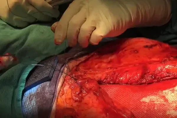 hernia surgery with GORE(R) SYNECOR Biomaterial