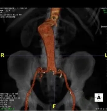 3D medical scan showing the abdominal aorta and branching iliac arteries highlighted in orange over a grayscale view of the pelvis, with orientation markers and scan data text visible on screen