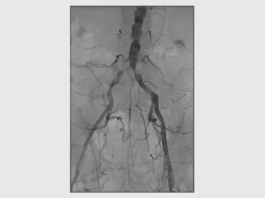 GORE VIABAHN VBX Balloon Expandable Endoprosthesis 
