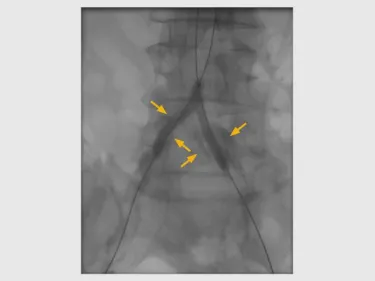 GORE VIABAHN VBX Balloon Expandable Endoprosthesis