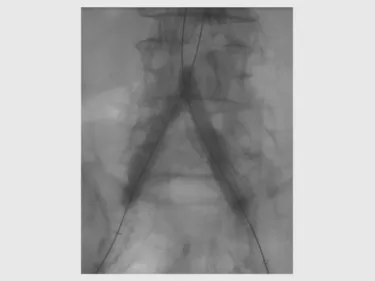 GORE VIABAHN VBX Balloon Expandable Endoprosthesis" loading="lazy"> 