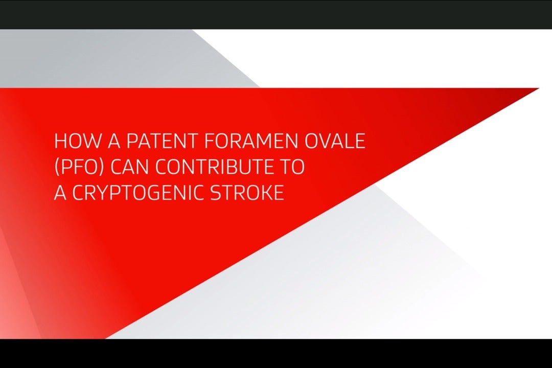 How a patent foramen ovale (PFO) can contribute to a cryptogenic stroke